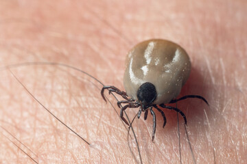 A tick drunk on blood crawls on human skin