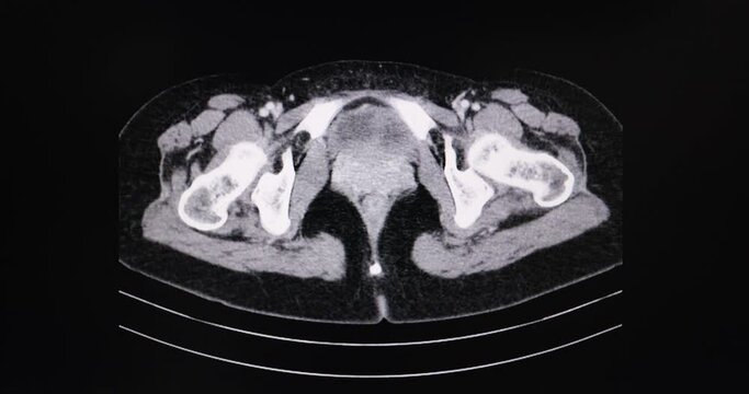 A motion CT scan of an abdomen of a female patient with carcinoma of the uterus.