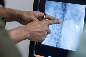 heart catheter when replacing an aortic valve