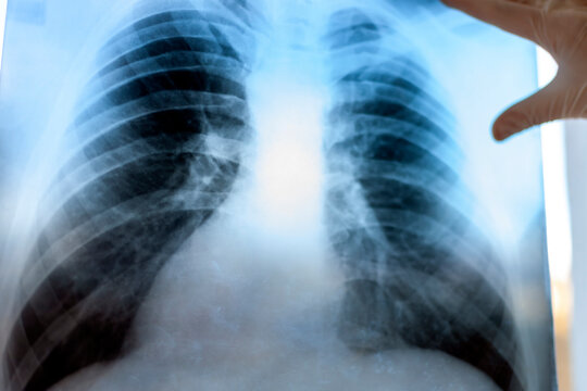 A female pneumologist holds a lung scan in her hands