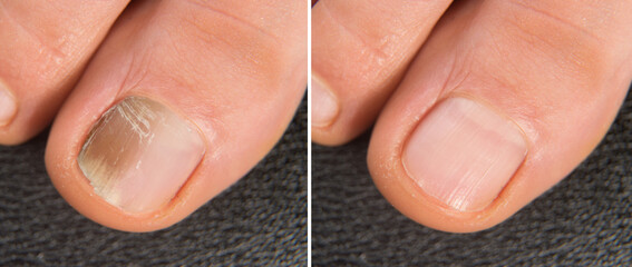 Big toe of a woman with nail affected by onychomycosis, close-up of before and after treatment with antifungal, close-up of before and after treatment with antifungal