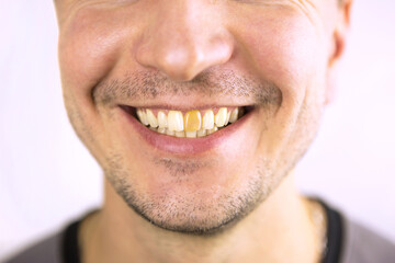 Fototapeta premium Yellow damaged tooth of a smiling Caucasian man in close-up. Focus on the teeth. Dental problems, dead teeth, enamel whitening, aesthetic restoration. Natural enamel, body positive