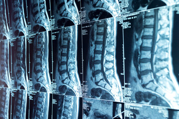 MRI scans of the lumbosacral spine - obrazy, fototapety, plakaty