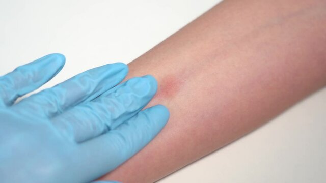 Closeup view 4k stock video footage of child's hand with red spot reaction to conducting Mantoux test after 72 hours from injection. Nurse in blue gloves applying transparent ruler to check reaction