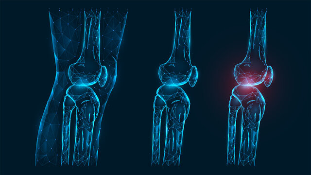 Polygonal vector illustration thigh and knee joint side view. Disease, pain, and inflammation of the knee joint. Low poly model of a healthy and injured human knee on a dark blue background