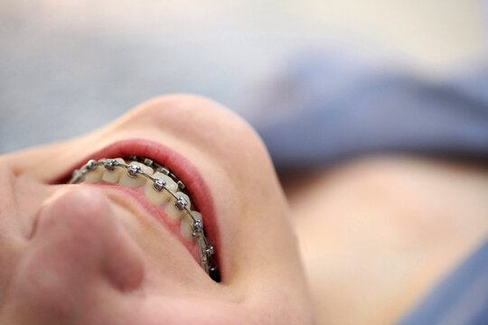 Smiling girl with braces close up.