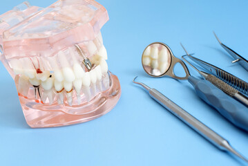 Fototapeta na wymiar Dentist tools and artificial jaw with prosthesis, caries, pulpitis on a blue background. Visual model of the jaw. The concept of bite correction