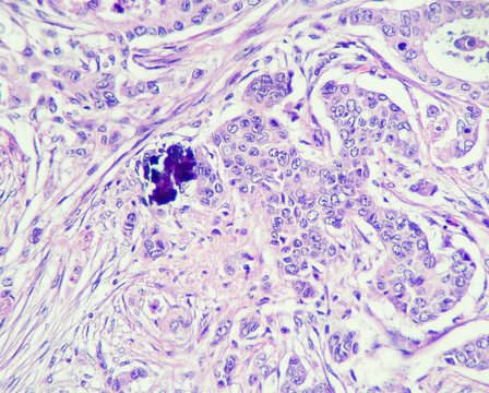 Photo of breast carcinoma with calcific focus, magnification 400x, photo under microscope