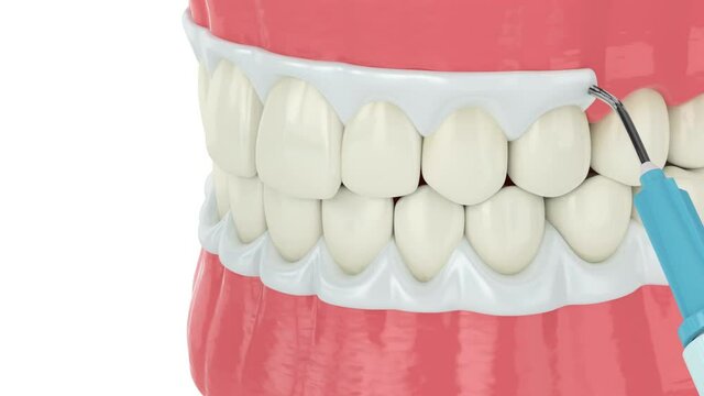 Professional teeth whitening by lamp over white background. Concept of different types of whitening teeth.