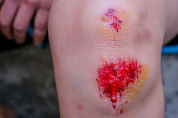 A woman falls and scratches her knee from running.