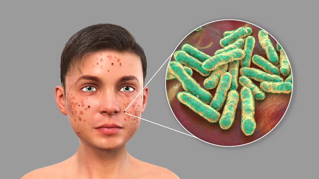 Acne Vulgaris And Bacteria Cutibacterium Acnes