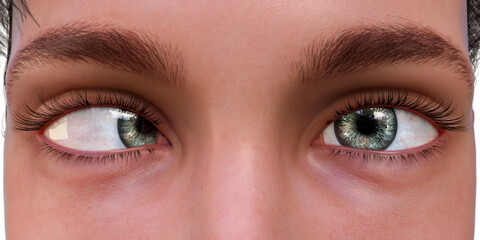 Strabismus, eyes deviation, illustration