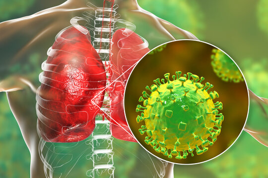 Nipah virus in lungs