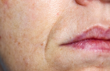 Nasolabial folds and enlarged pores on the female face. Skin care in 40 years.