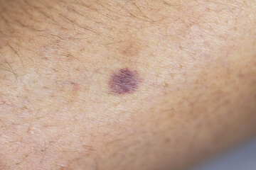 The physical appearance of the arm with the wound is caused by Haemophilia, (Haemophiliais a mostly...