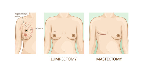 Mammary cancer. lumpectomy vs mastectomy - obrazy, fototapety, plakaty