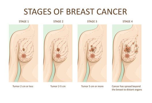 Stages of breast cancer. Medical illustration