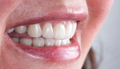 Obraz premium Emax press ceramic crowns and venners