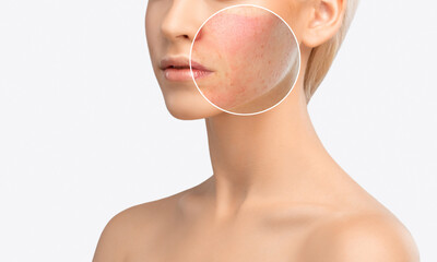 A young girl with a problem skin. Photo before and after treatment for acne and Demodecosis. Skin...