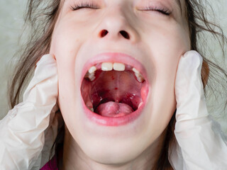 close-up of angina in a child, purulent herpes tonsillitis, red sore throat of a little girl