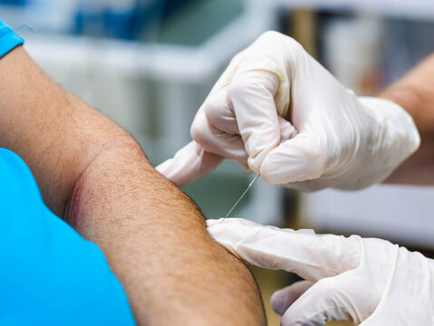 Closeup anonymous doctor in latex gloves inserting needle into arm of patient during acupuncture therapy in clinic