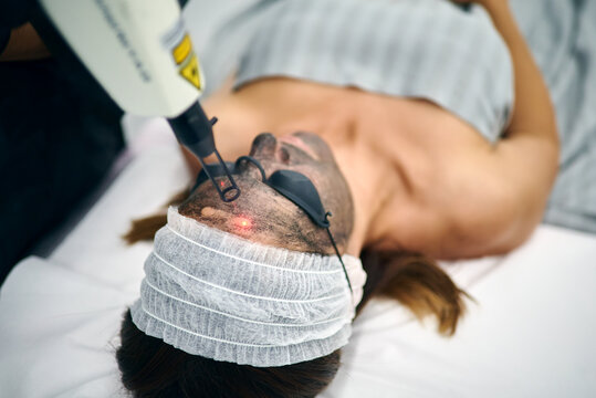Anonymous cosmetician using machine for carbon peel on face of female client lying in protective glasses in beauty clinic