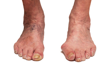 Legs of an old sick man. On a white isolated background.