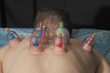 Dealing with the body. Back massage and treatment, vacuum jars