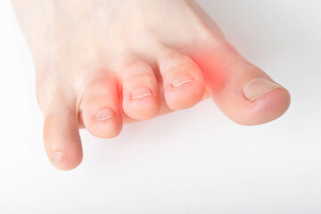 A crooked and stiff toe on a white background. Interdigital neuralgia, macro, copy space for text