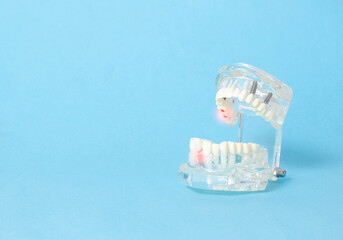 Dental jaw model on a blue background. Dental disease concept, inflammation and pain, gum redness....