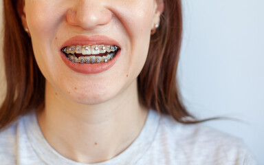 Braces in the smiling mouth of a girl. Smooth teeth from braces.