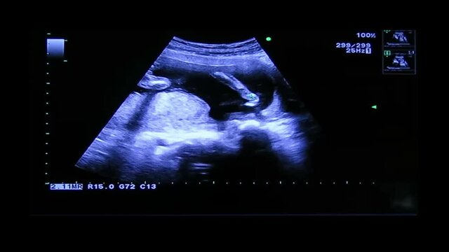 Arm right and arm left of human embryo on an ultrasound display