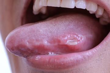 Man Showing His Sprue In Tongue