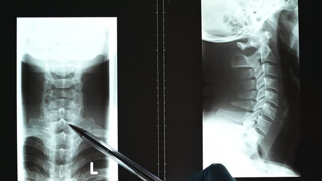 Doctor pointing at neck x-ray or CT scan image