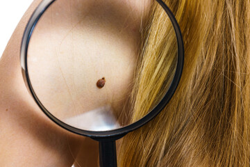 Closeup brown mole on skin.