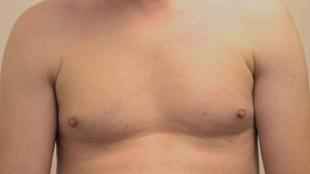 Obese male breasts. Overweight problems