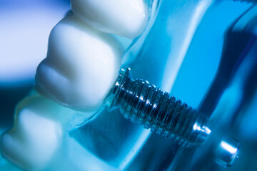 Dental tooth implant