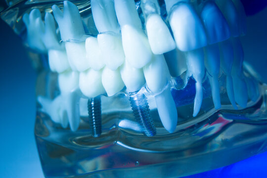 Dental tooth implant