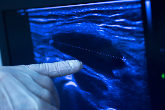 EPI dry needling ultrasound scan