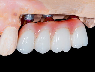 zirkon bridges in implants