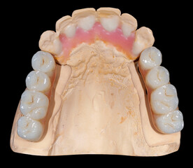 zirkon bridges in implants
