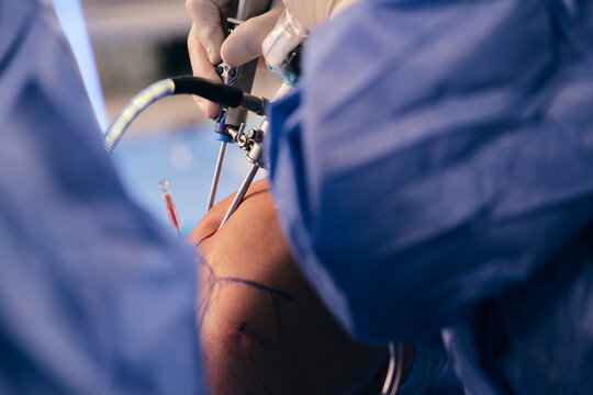 Doctor inserting endoscopic equipment while doing operation at operating room