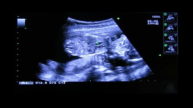 Diaphragm of human embryo on an ultrasound display