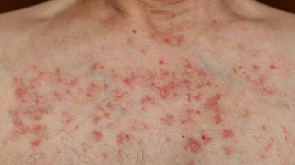 Skin reaction on a man chest after chemotherapy. Allergic reaction. Allergic rash on chest skin