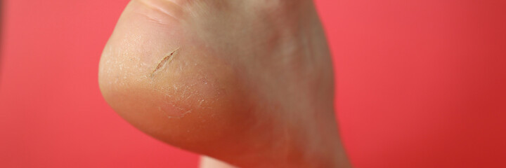 Close-up of badly cracked heel. Persons feet with dry skin. Barefoot adult with unattractive and unhealthy foot. Salon treatment and skin procedure needed concept