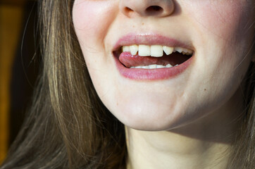Lack of lateral incisors. Teeth before placing