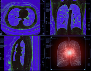 Selective focus of CT Chest or Lung 3D rendering image on the monitor  for diagnosis TB,tuberculosis and covid-19 .