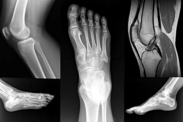 Collage Orthopedic of Foot and Knee XRay - 410475831