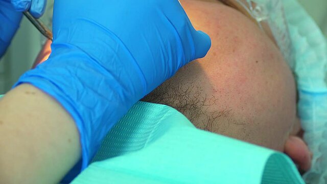 a dentist in a stamotological clinic fills a diseased tooth and pulpitis at a tooth nerve, and also cleans teeth from plaque and caries
