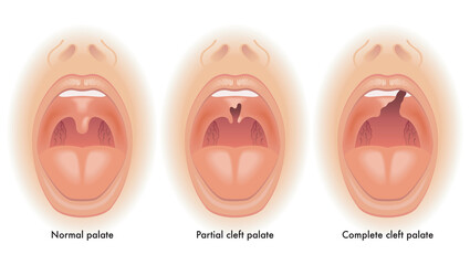 Medical illustration shows the difference between a normal palate, a partial cleft palate, and a complete cleft palate, with annotations.